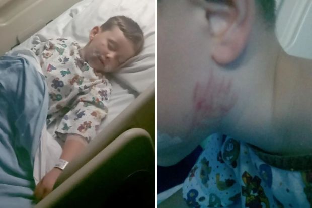 An image collage containing 2 images, Image 1 shows Four-year-old boy sleeping in a hospital bed with injuries, Image 2 shows Photo of a child's neck with injuries from a dog attack