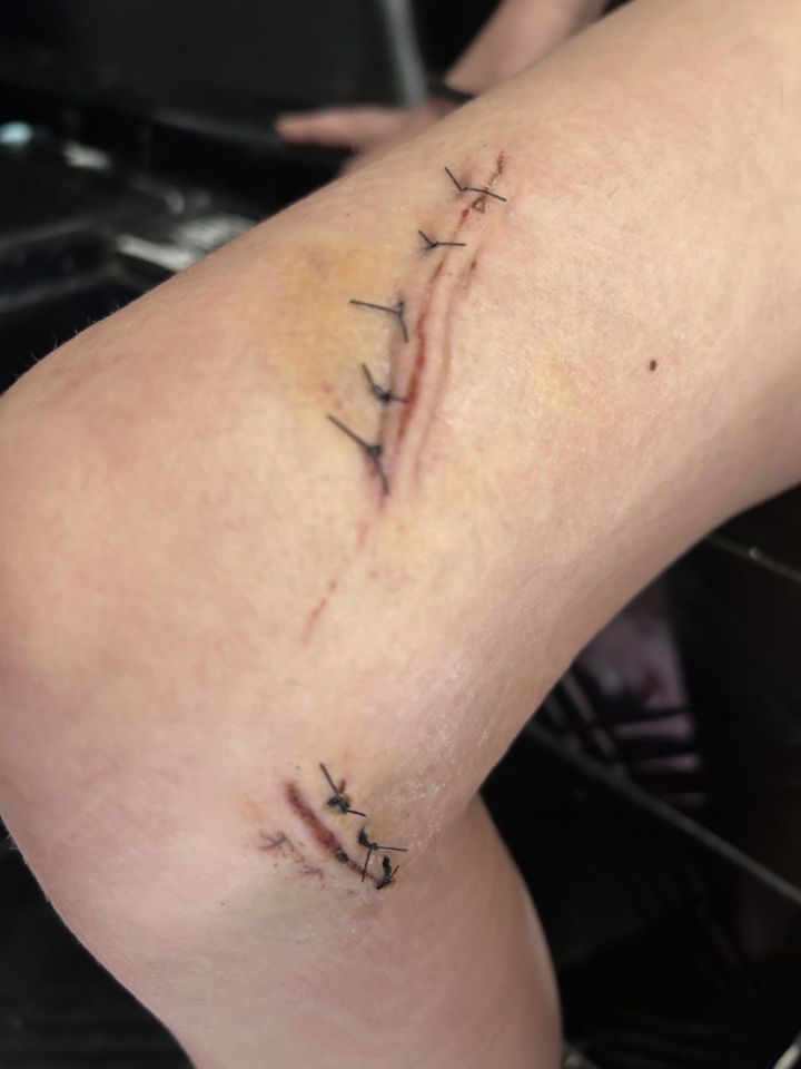 Close-up of a stitched leg wound.