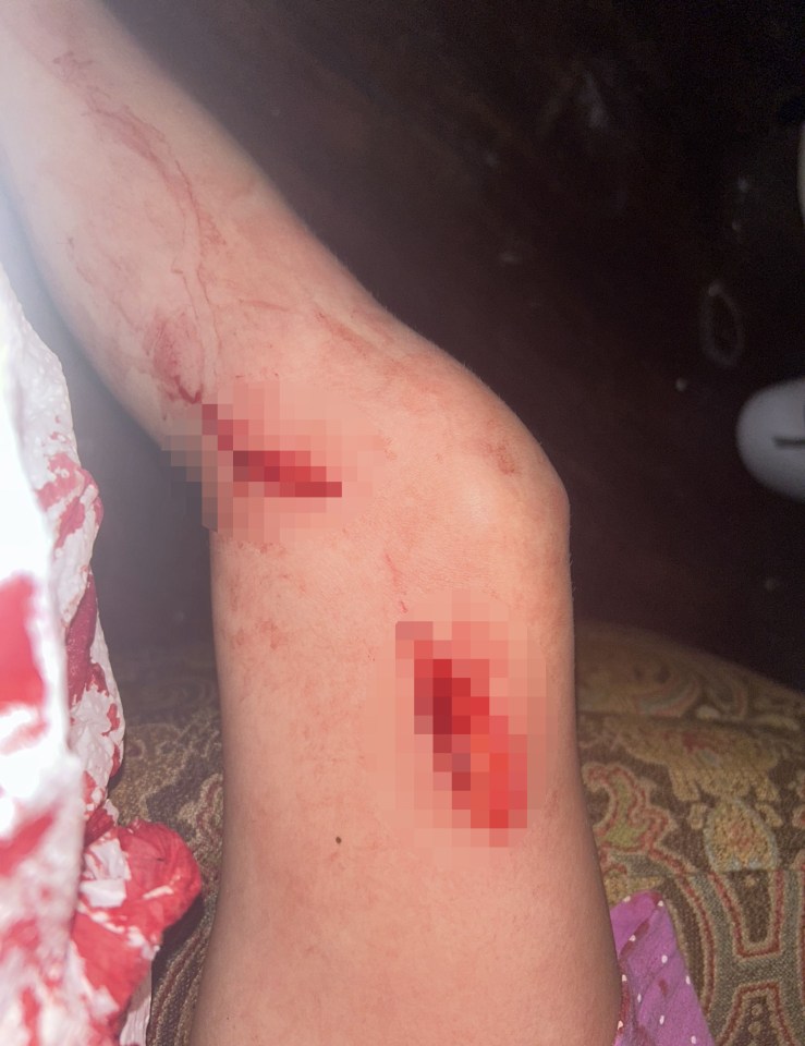 Photo of a child's leg with two deep cuts.